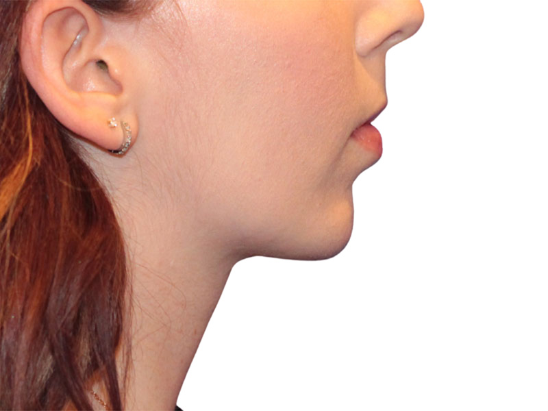 Chin Augmentation Before and After | PERK Plastic Surgery