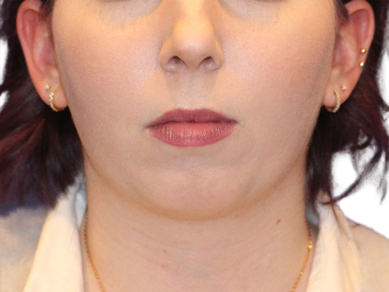 Chin Augmentation Before and After | PERK Plastic Surgery
