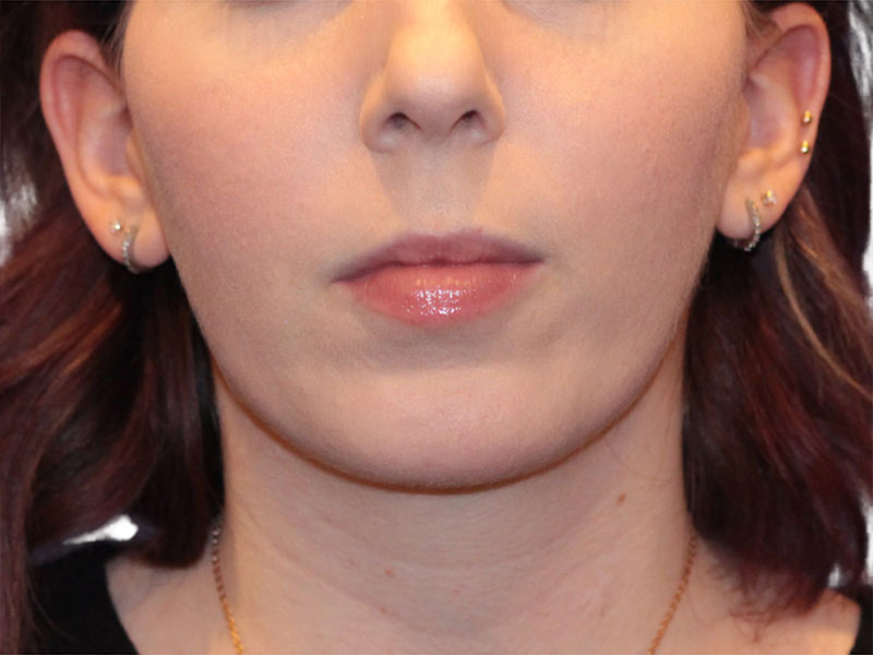 Chin Augmentation Before and After | PERK Plastic Surgery