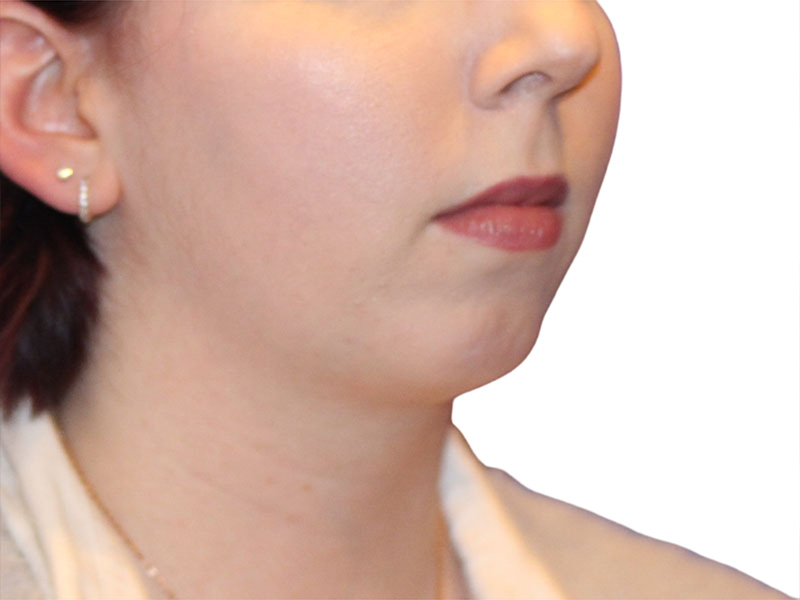 Chin Augmentation Before and After | PERK Plastic Surgery