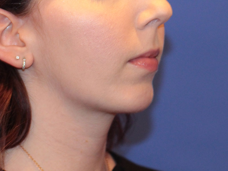 Chin Augmentation Before and After | PERK Plastic Surgery