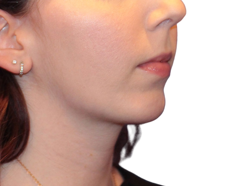 Chin Augmentation Before and After | PERK Plastic Surgery