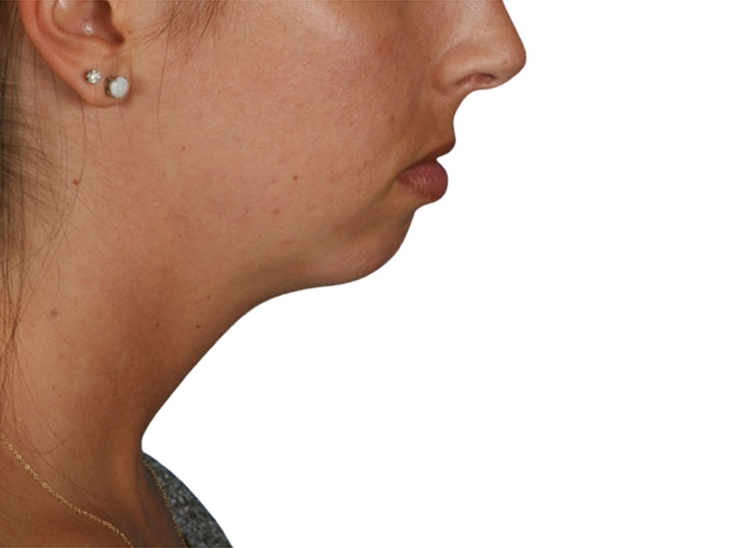 Chin Augmentation Before and After | PERK Plastic Surgery