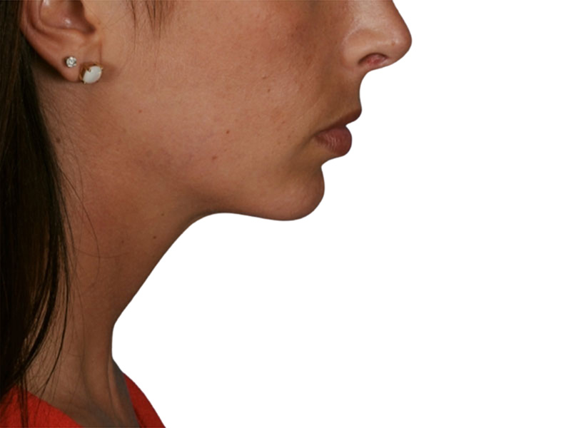 Chin Augmentation Before and After | PERK Plastic Surgery