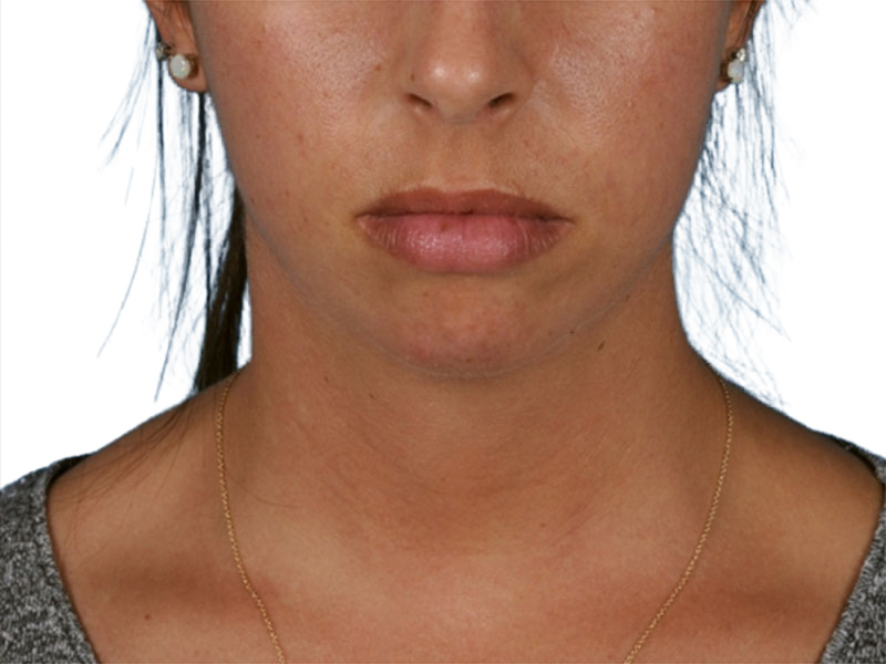 Chin Augmentation Before and After | PERK Plastic Surgery