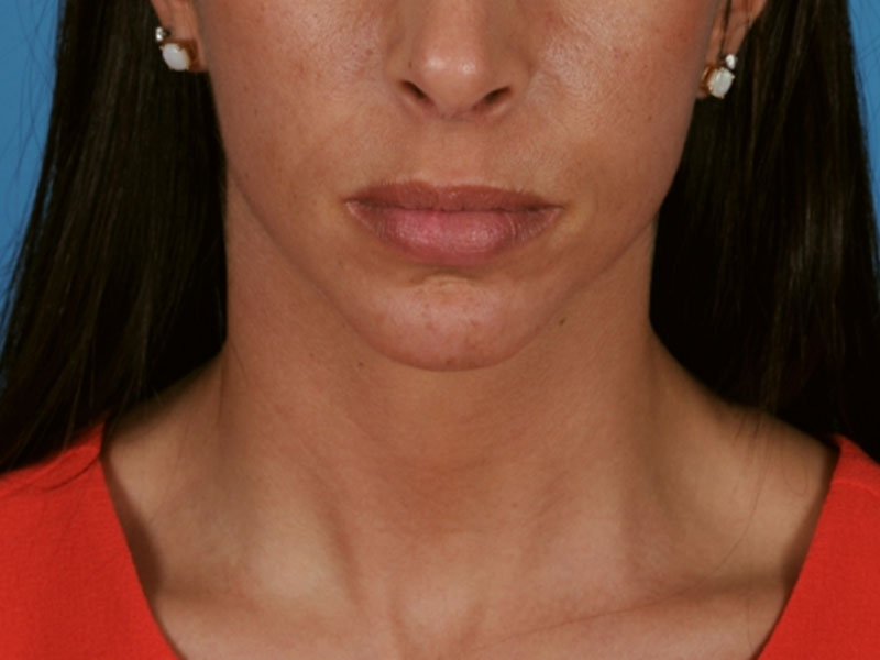 Chin Augmentation Before and After | PERK Plastic Surgery