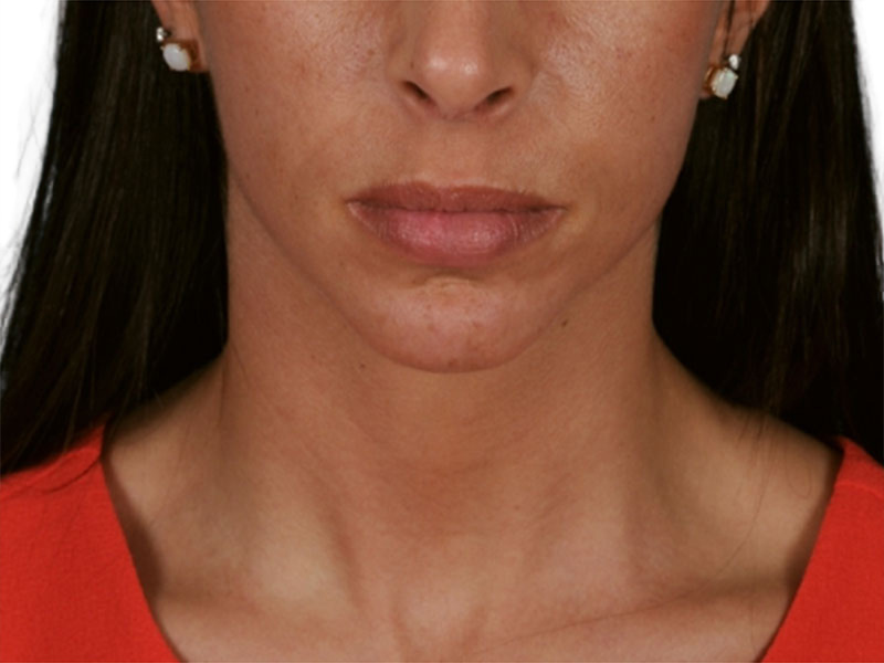 Chin Augmentation Before and After | PERK Plastic Surgery