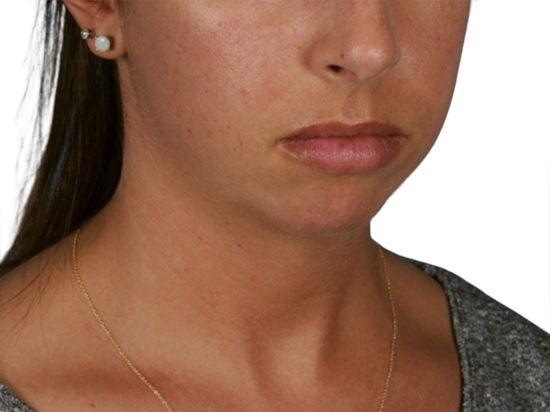 Chin Augmentation Before and After | PERK Plastic Surgery