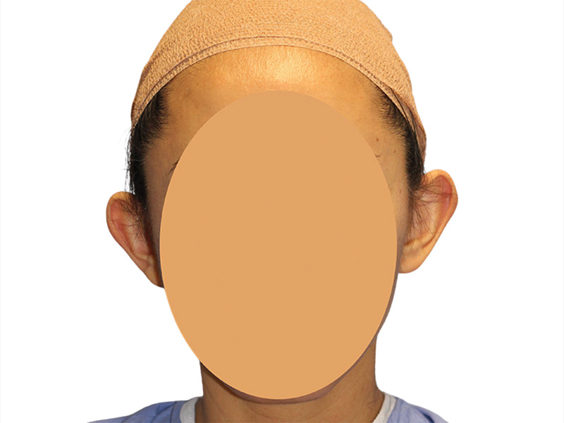 Ear Surgery Before and After | PERK Plastic Surgery