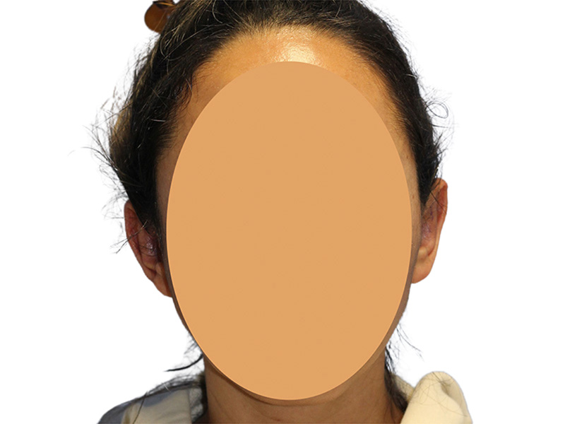Ear Surgery Before and After | PERK Plastic Surgery