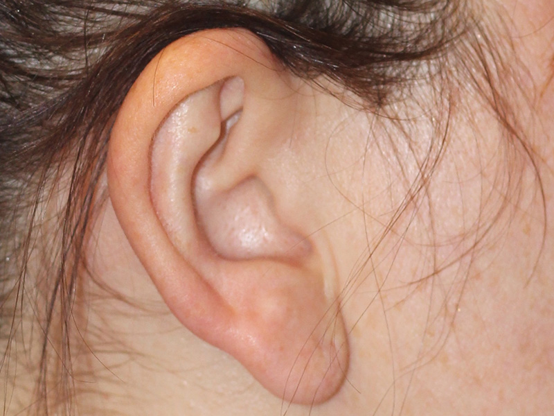 Ear Surgery Before and After | PERK Plastic Surgery