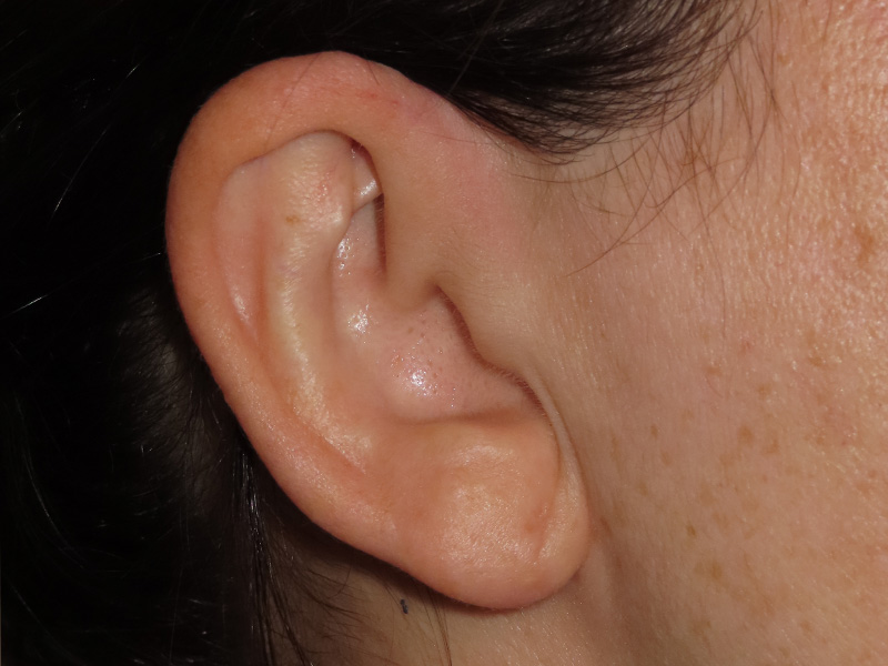 Ear Surgery Before and After | PERK Plastic Surgery