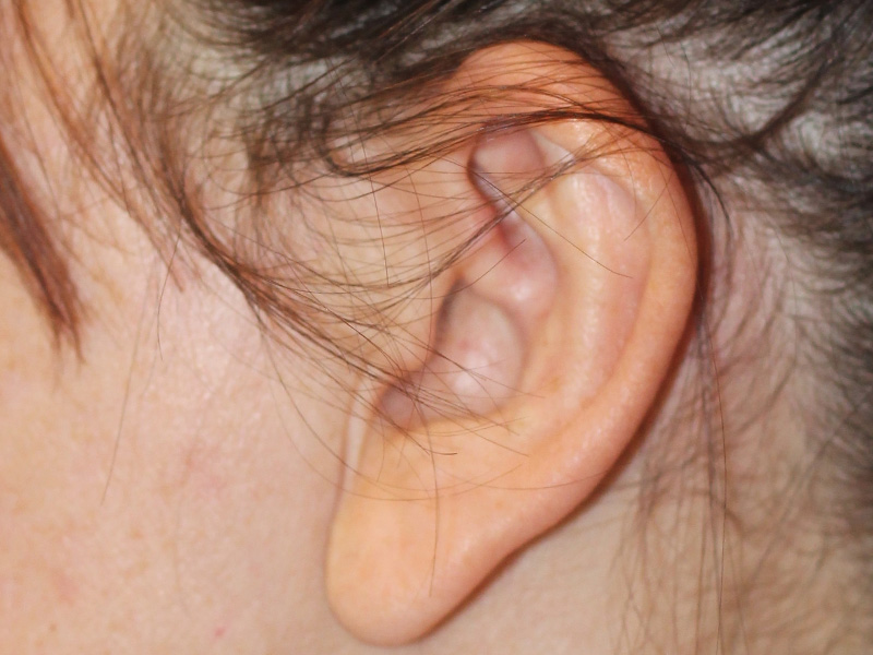 Ear Surgery Before and After | PERK Plastic Surgery