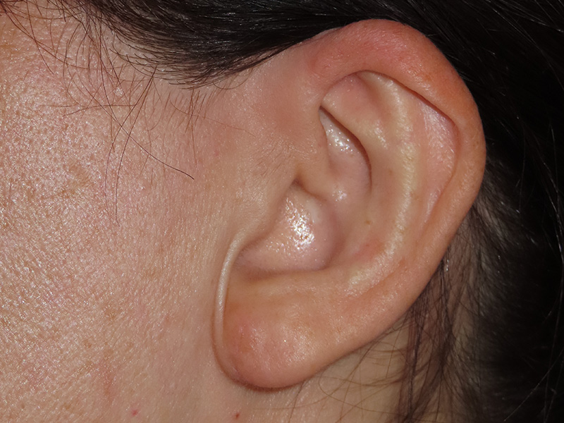 Ear Surgery Before and After | PERK Plastic Surgery