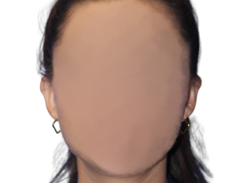 Earlobe Repair Beverly Hills