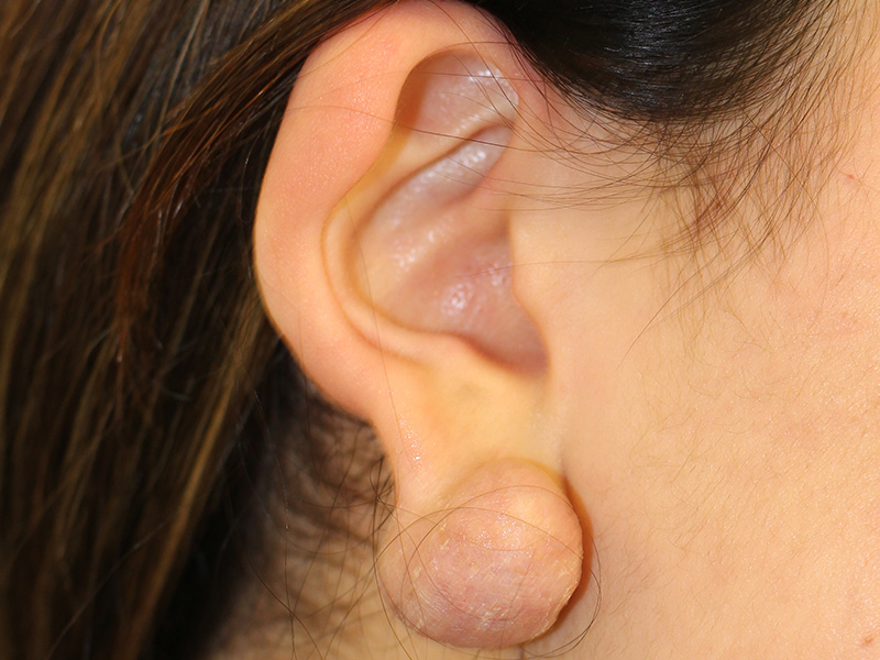 Ear Surgery Before and After | PERK Plastic Surgery
