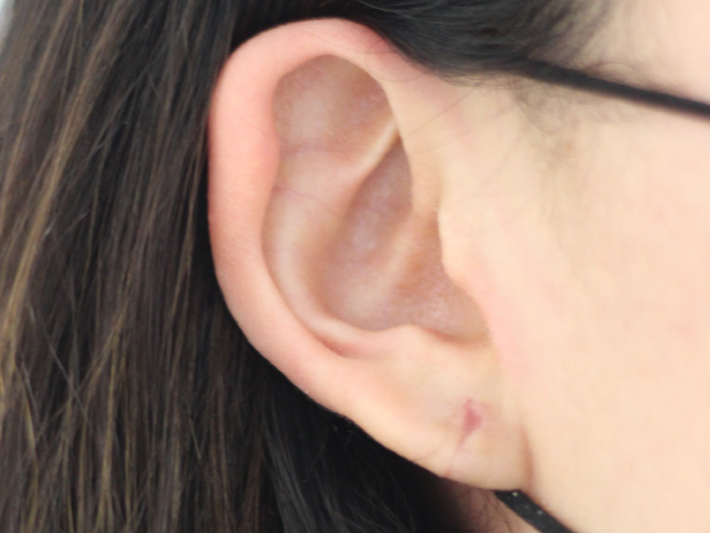 Ear Surgery Before and After | PERK Plastic Surgery
