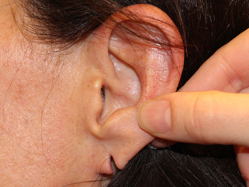Ear Surgery Before and After | PERK Plastic Surgery