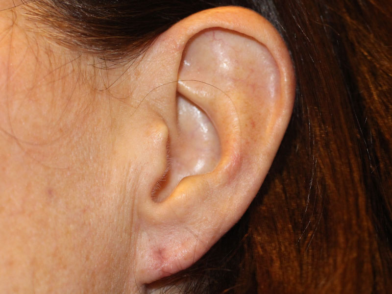 Ear Surgery Before and After | PERK Plastic Surgery