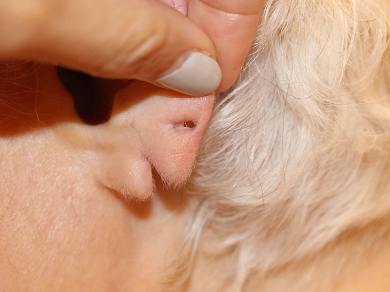 Ear Surgery Before and After | PERK Plastic Surgery