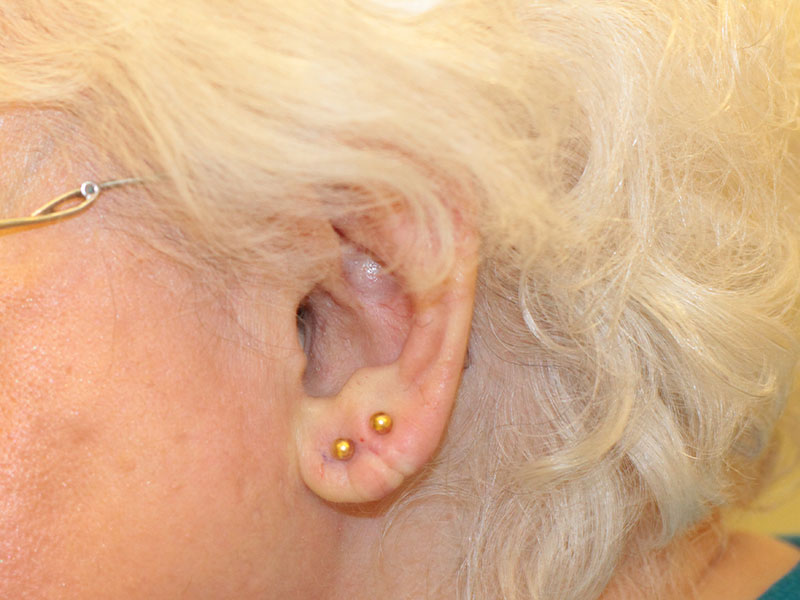 Ear Surgery Before and After | PERK Plastic Surgery