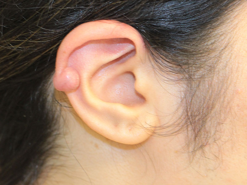 Ear Surgery Before and After | PERK Plastic Surgery