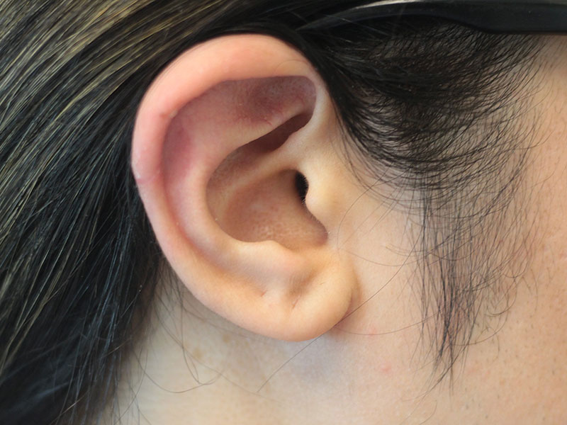 Ear Surgery Before and After | PERK Plastic Surgery