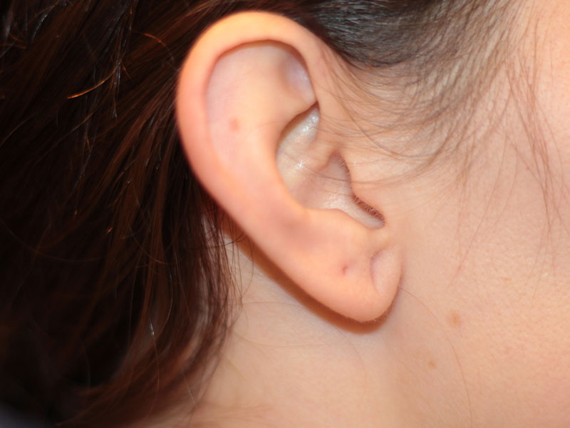 Ear Surgery Before and After | PERK Plastic Surgery