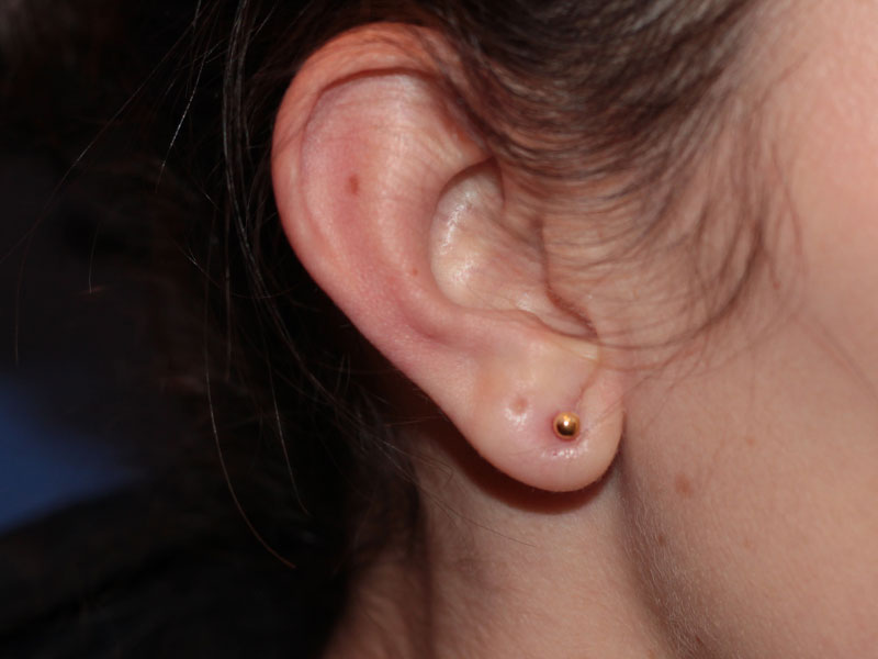Ear Surgery Before and After | PERK Plastic Surgery