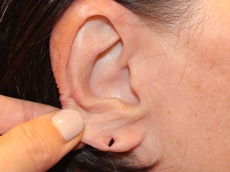 Ear Surgery Before and After | PERK Plastic Surgery