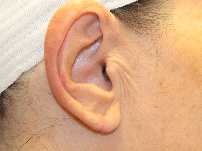 Earlobe Repair Beverly Hills
