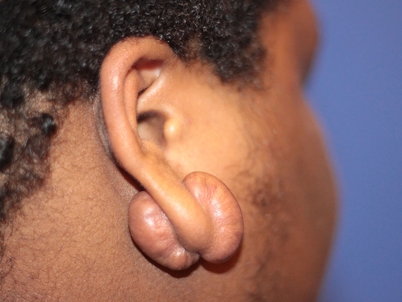 Ear Surgery Before and After | PERK Plastic Surgery