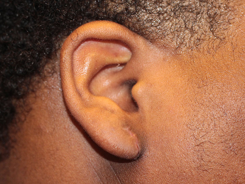 Ear Surgery Before and After | PERK Plastic Surgery