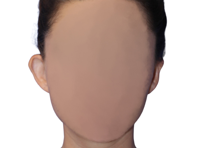 Earlobe Repair Beverly Hills