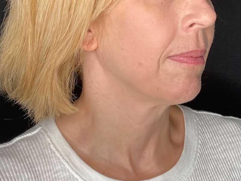 Facial Fat Grafting Beverly Hills