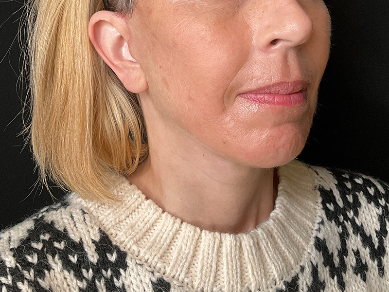 Facial Fat Grafting Beverly Hills
