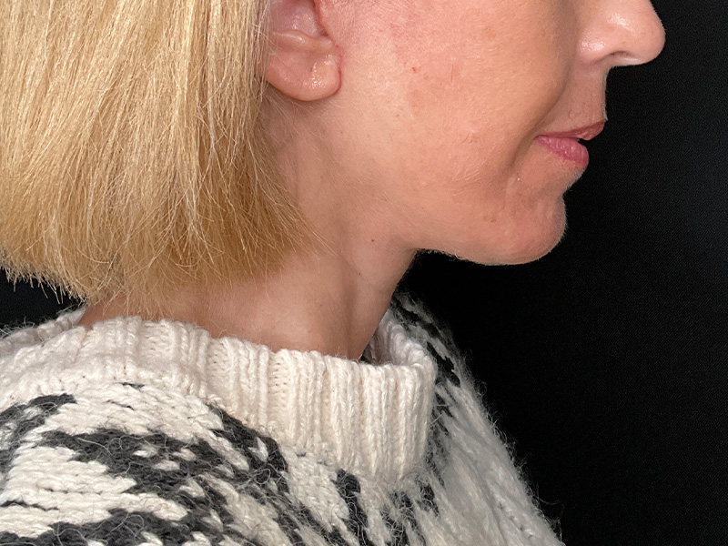 Facelift Before and After | PERK Plastic Surgery