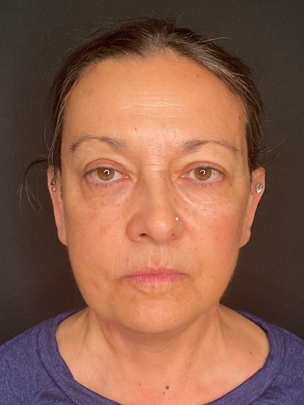 Natural Facelift Beverly Hills
