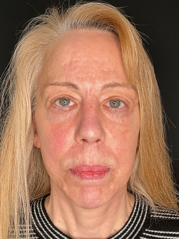 Facelift Before and After | PERK Plastic Surgery
