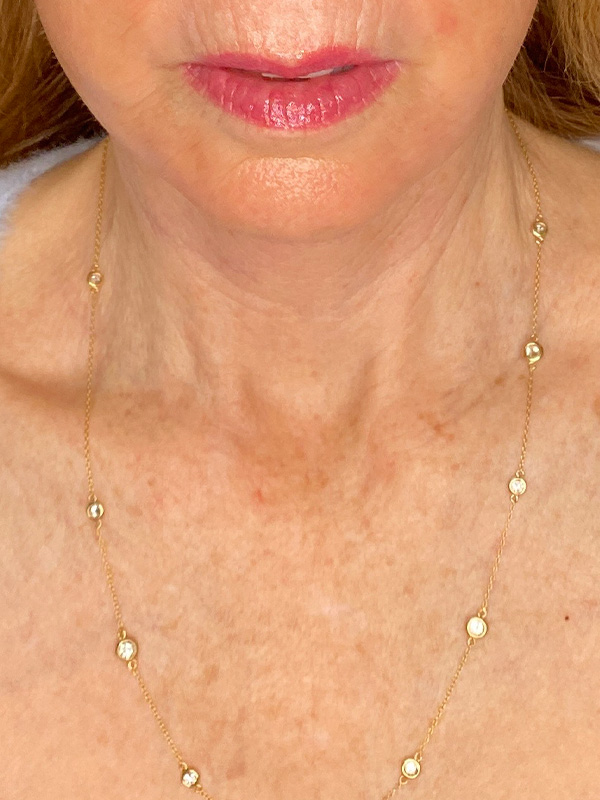 Facelift Before and After | PERK Plastic Surgery
