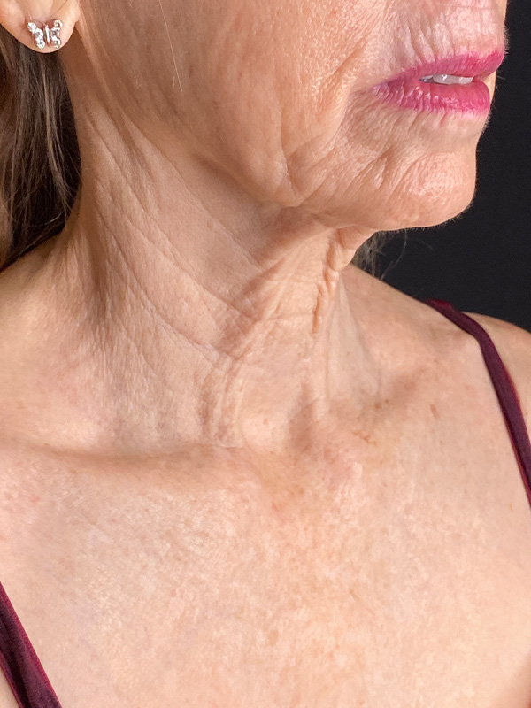 Facelift Before and After | PERK Plastic Surgery