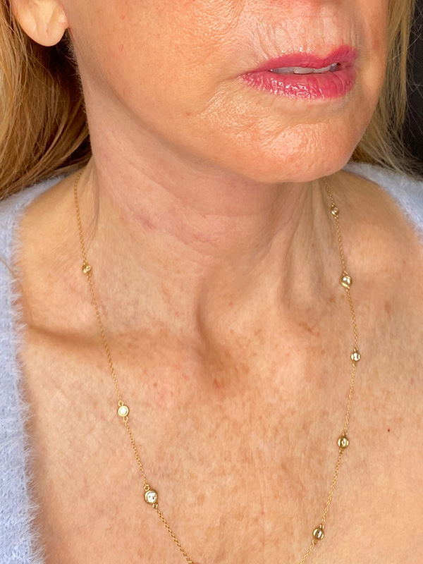 Facelift Before and After | PERK Plastic Surgery