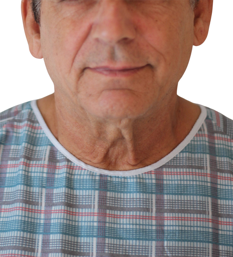 Facelift Before and After | PERK Plastic Surgery