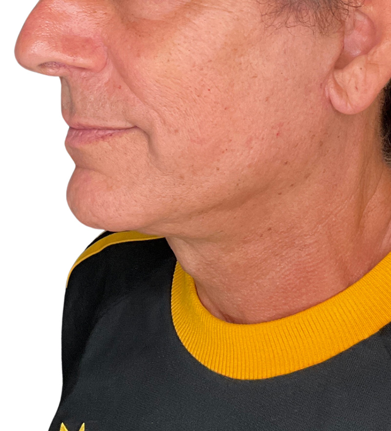 Facelift Before and After | PERK Plastic Surgery