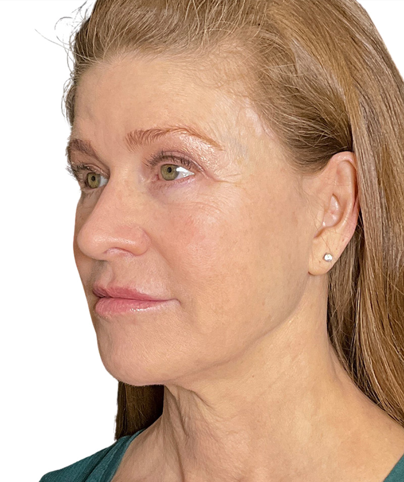 Facelift Before and After | PERK Plastic Surgery