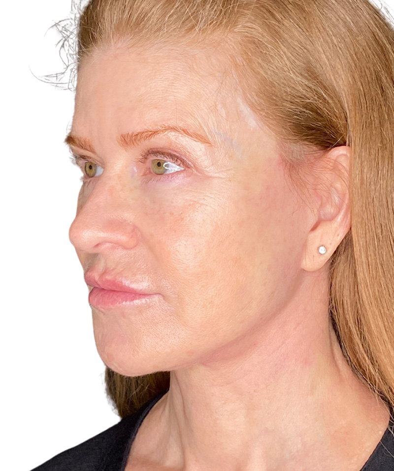 Facelift Before and After | PERK Plastic Surgery