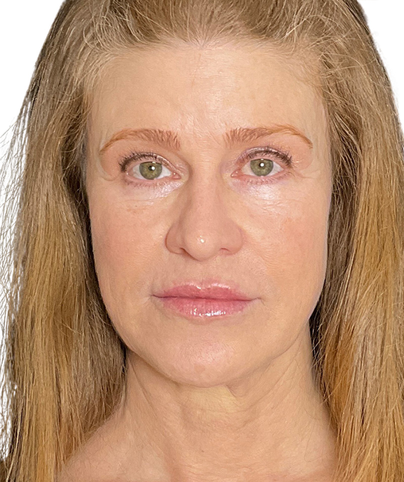 Facelift Before and After | PERK Plastic Surgery