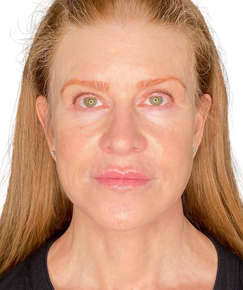 Facelift Before and After | PERK Plastic Surgery