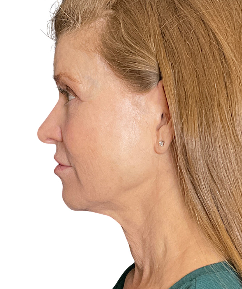 Facelift Before and After | PERK Plastic Surgery