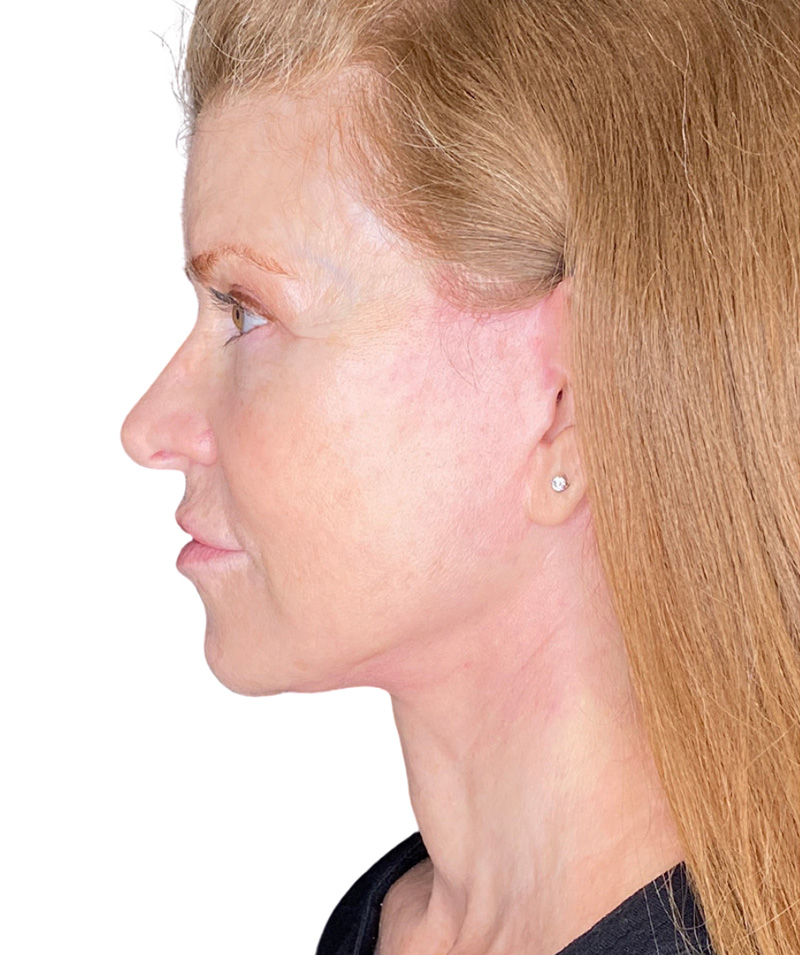 Facelift Before and After | PERK Plastic Surgery